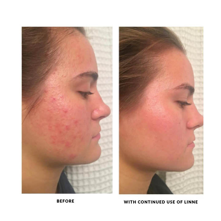 Battling Hormonal Acne